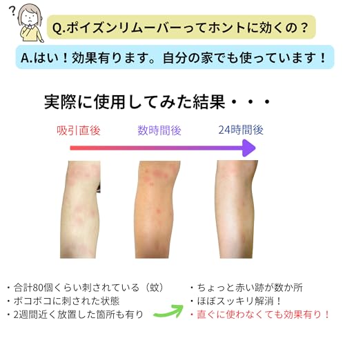 NEW エクストラクター ポイズンリムーバー 強力型 ハチ ブヨ トコジラミ ヤマビル などの虫刺され 毒吸引に (通常版, 1, セット) (通常版)の特徴・詳細 画像